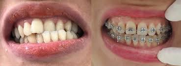 CHỈNH NHA- NIỀNG RĂNG TRẢ GÓP 0 % TẠI THỦY NGUYÊN HẢI PHÒNG